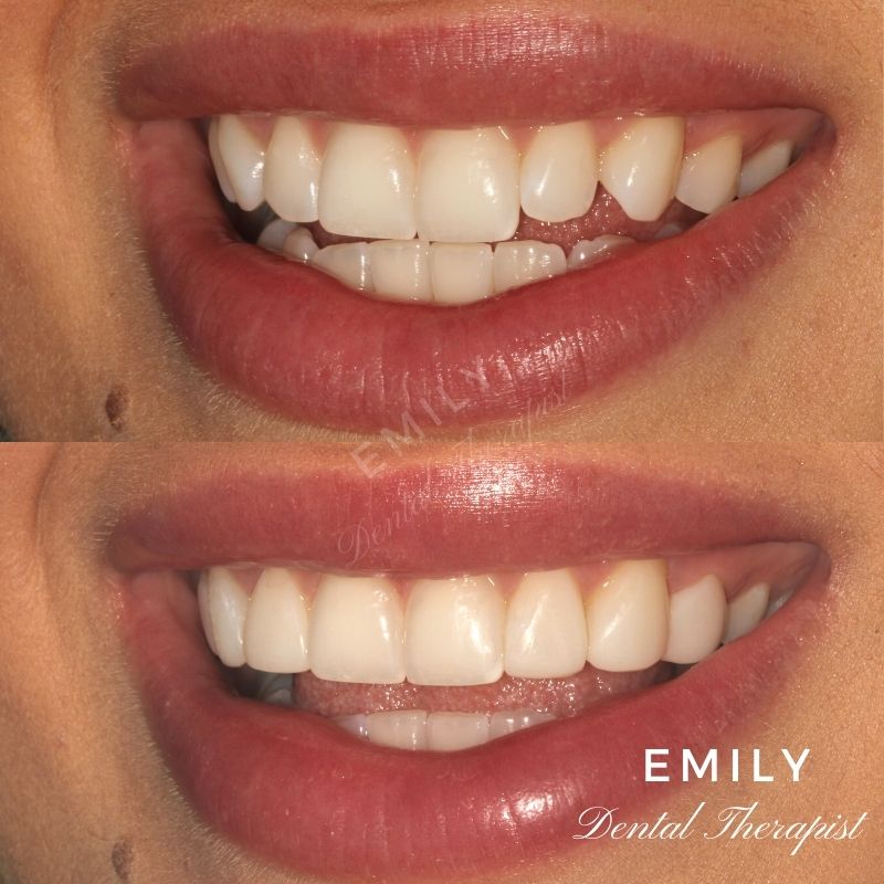 Composite Bonding Emily Dental Therapist Birmingham and Bristol